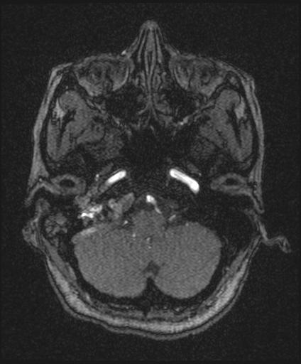 Bilateral carotid body tumors and right glomus jugulare tumor (Radiopaedia 20024-20060 Axial MRA 33).jpg