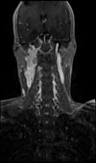 Bilateral carotid body tumors and right glomus jugulare tumor (Radiopaedia 20024-20060 MRA 37).jpg