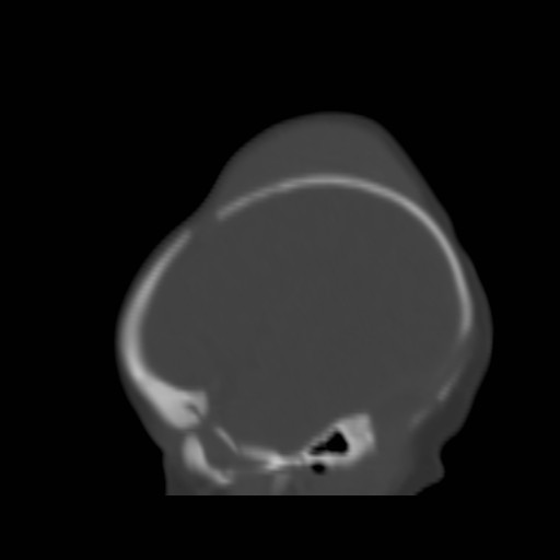 File:Bilateral cephalohematomas and subdural hematomas (Radiopaedia 26778-26929 Sagittal bone window 34).jpg
