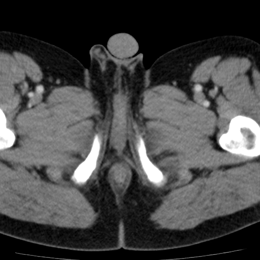 File:Bilateral direct inguinal herniae (Radiopaedia 17016-16719 B 33).jpg