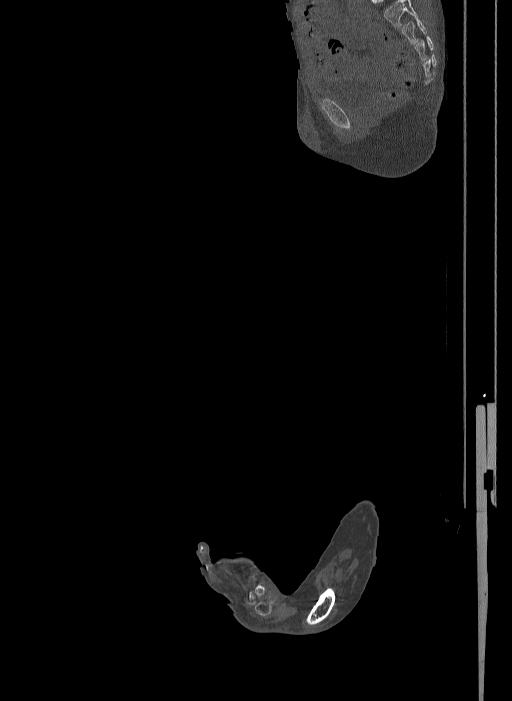 Bilateral fibular hemimelia type II (Radiopaedia 69581-79491 Sagittal bone window 50).jpg