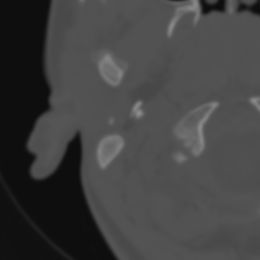 File:Bilateral otosclerosis (Radiopaedia 57237-64157 B 3).jpg