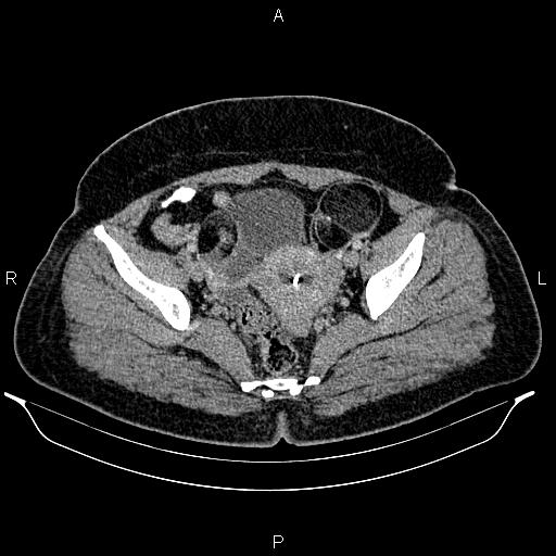 Bilateral ovarian dermoid cysts (Radiopaedia 85785-101603 A 91).jpg