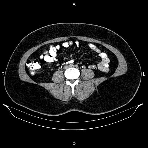 Bilateral ovarian dermoid cysts (Radiopaedia 85785-101603 Axial C+ delayed 45).jpg