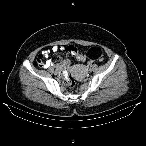 Bilateral ovarian dermoid cysts (Radiopaedia 85785-101603 Axial C+ delayed 66).jpg