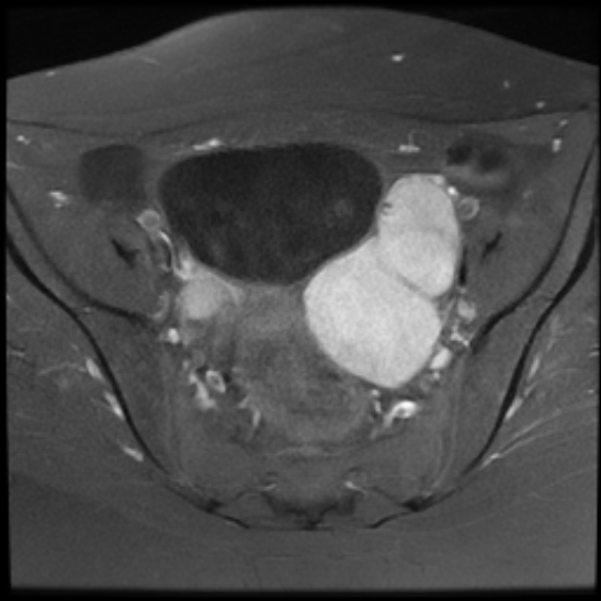 File:Bilateral ovarian fibrothecomas - adolescent (Radiopaedia 86604-102707 Axial T1 C+ fat sat 13).jpg