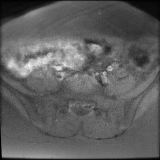 File:Bilateral ovarian fibrothecomas - adolescent (Radiopaedia 86604-102707 Axial T1 fat sat 5).jpg
