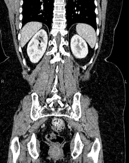 Bilateral ovarian serous cystadenocarcinoma (Radiopaedia 86062-101989 D 41).jpg