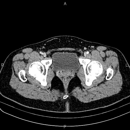 Bilateral ovarian teratoma (Radiopaedia 83131-97503 Axial With contrast 71).jpg