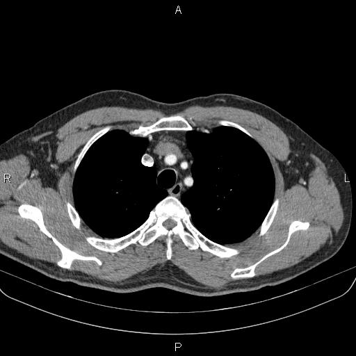 Bilateral pulmonary AVM (Radiopaedia 83134-97505 A 17).jpg