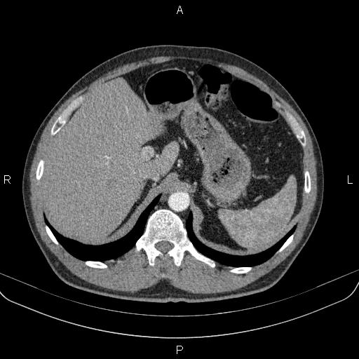 Bilateral pulmonary AVM (Radiopaedia 83134-97505 A 72).jpg