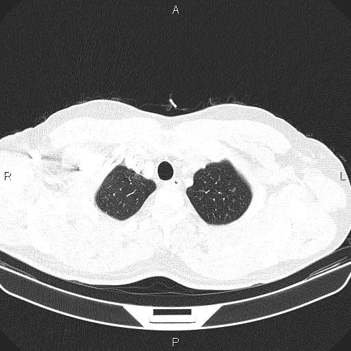 File:Bilateral pulmonary AVM (Radiopaedia 83134-97505 Axial lung window 10).jpg