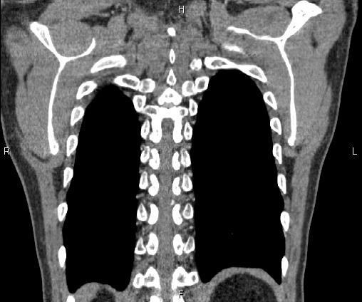 Bilateral pulmonary AVM (Radiopaedia 83134-97505 C 64).jpg