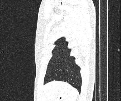 Bilateral pulmonary AVM (Radiopaedia 83134-97505 Sagittal lung window 21).jpg