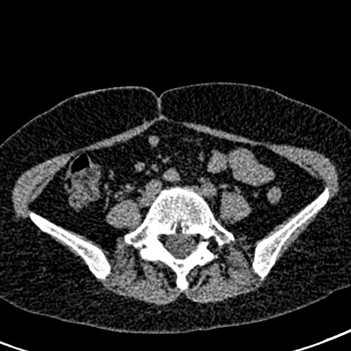 Bilateral staghorn calculi (Radiopaedia 59475-66842 Axial non-contrast 50).jpg
