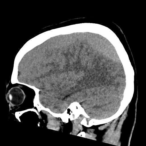 File:Bilateral subacute subdural hematoma (Radiopaedia 69240-79018 C 15).jpg