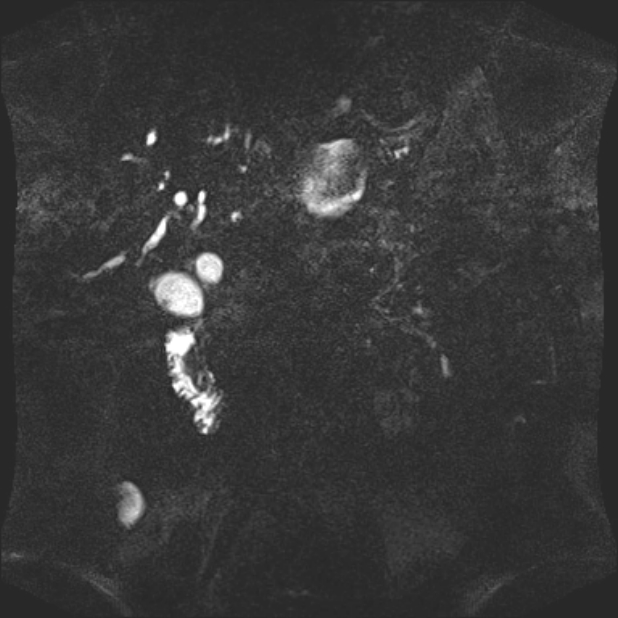 Biliary pancreatitis (Radiopaedia 72289-82824 Coronal 3D T2 64).jpg