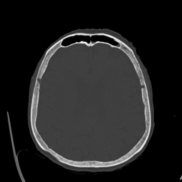 Biparietal osteodystrophy (Radiopaedia 46109-50463 bone window 43).jpg