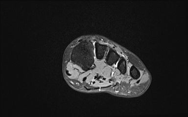 Bipartite hallux sesamoid diastasis (Radiopaedia 77133-89109 Coronal T2 fat sat 9).jpg