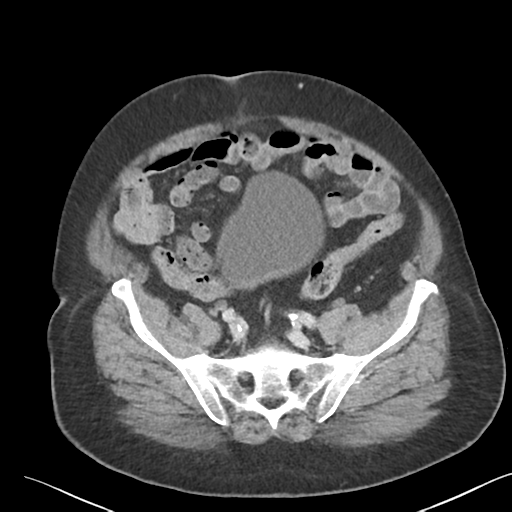 File:Bladder papillary urothelial carcinoma (Radiopaedia 48119-52951 Axial 43).png