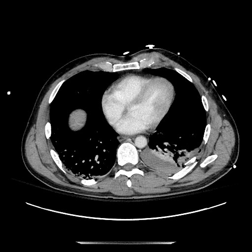 Blunt abdominal trauma with solid organ and musculoskelatal injury with active extravasation (Radiopaedia 68364-77895 A 1).jpg