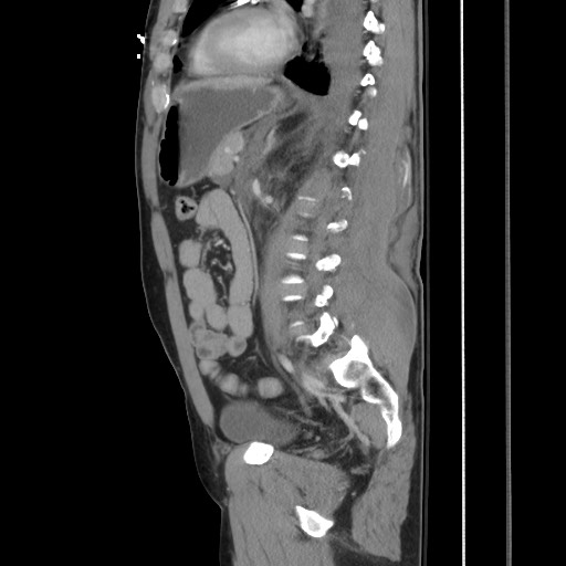 File:Blunt abdominal trauma with solid organ and musculoskelatal injury with active extravasation (Radiopaedia 68364-77895 C 89).jpg