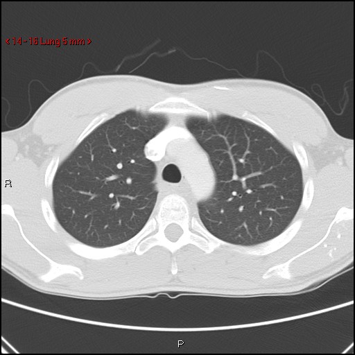 Blunt chest trauma - pulmonary interstitial emphysema and pneumomediastinum (Radiopaedia 20666-20552 Axial lung window 16).jpg