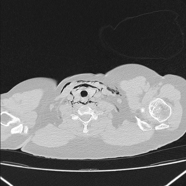 Boerhaave syndrome (Radiopaedia 45644-49799 Axial lung window 20).jpg
