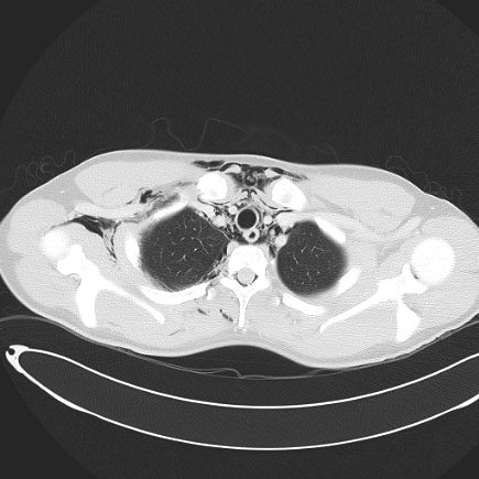 Boerhaave syndrome with mediastinal, axillary, neck and epidural free gas (Radiopaedia 41297-44115 Axial lung window 31).jpg