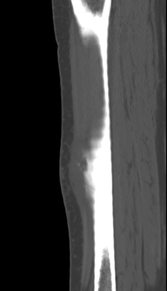Bone metastasis - tibia (Radiopaedia 57665-64609 Sagittal bone window 110).jpg