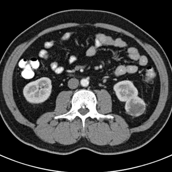 File:Bosniak cyst - type IV (Radiopaedia 23525-23627 renal cortical phase 38).jpg