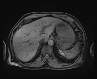 Bouveret syndrome (Radiopaedia 61017-68856 Axial T1 fat sat 17).jpg