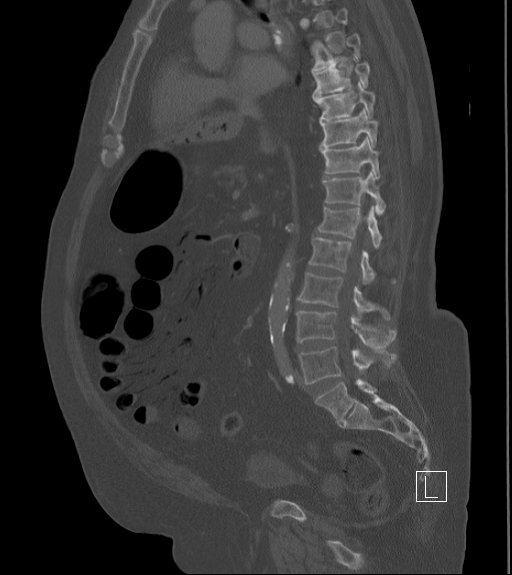 Bowel ischemia secondary to SMA occlusion with extensive portomesenteric venous gas (Radiopaedia 54656-60871 Sagittal bone window 53).jpg