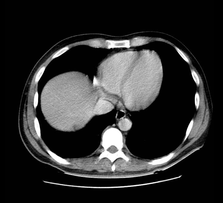 Bowel obstruction from colon carcinoma (Radiopaedia 22995-23028 A 6).jpg