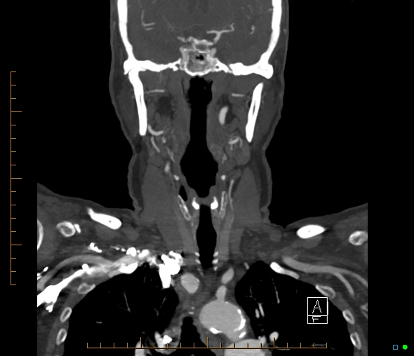 Brachiocephalic trunk stenosis (Radiopaedia 87242-103519 B 34).jpg