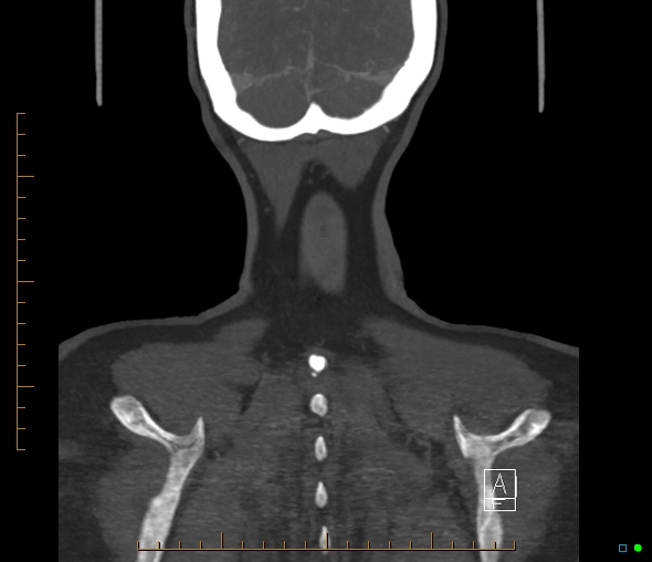 Brachiocephalic trunk stenosis (Radiopaedia 87242-103519 B 70).jpg