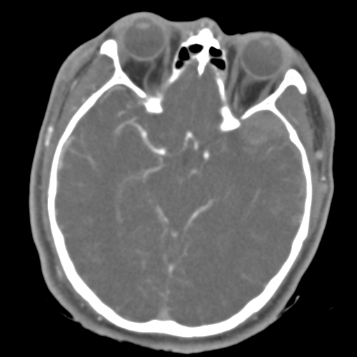 File:Brain contusions, internal carotid artery dissection and base of skull fracture (Radiopaedia 34089-35339 D 32).png
