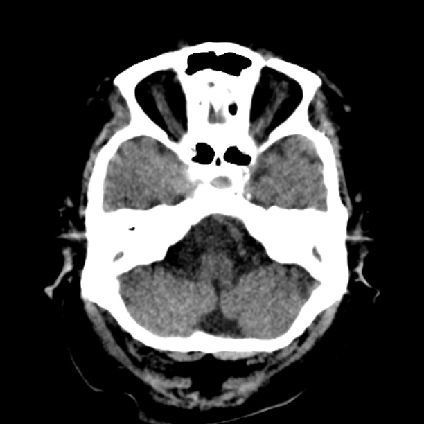 Brain cortical laminar necrosis (Radiopaedia 25822-25971 Axial non-contrast 8).jpg