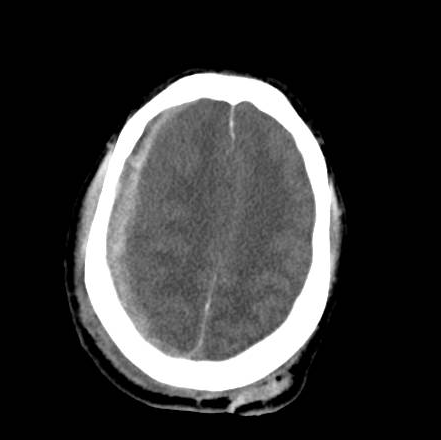 File:Brain death after motor vehicle collision (Radiopaedia 88470-105114 Axial 16).png