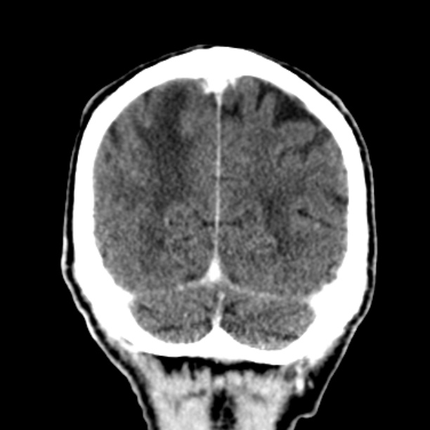 Brain metastases from lung cancer (Radiopaedia 27849-28092 Coronal C+ delayed 55).jpg