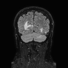 File:Brain metastases from lung cancer (Radiopaedia 83839-99028 Coronal FLAIR 67).jpg