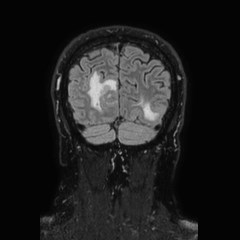 Brain metastases from lung cancer (Radiopaedia 83839-99028 Coronal FLAIR 71).jpg