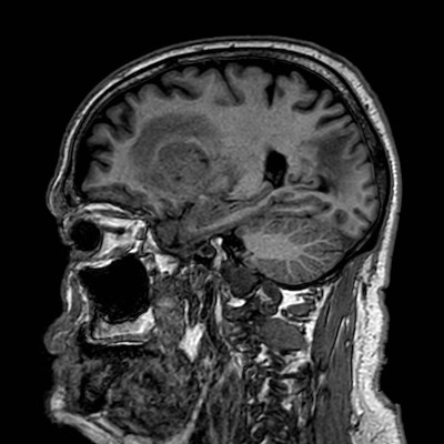 Brain metastases from lung cancer (Radiopaedia 83839-99028 Sagittal T1 42).jpg