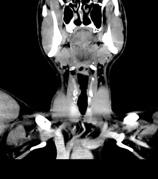 Branchial cleft cyst (Radiopaedia 31167-31875 Coronal C+ delayed 26).jpg