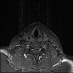 File:Branchial cleft cyst (Radiopaedia 31167-31876 Axial T1 C+ fat sat 1).jpg