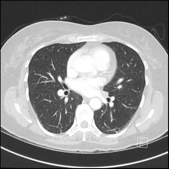 Breast metastases from renal cell cancer (Radiopaedia 79220-92225 Axial lung window 45).jpg