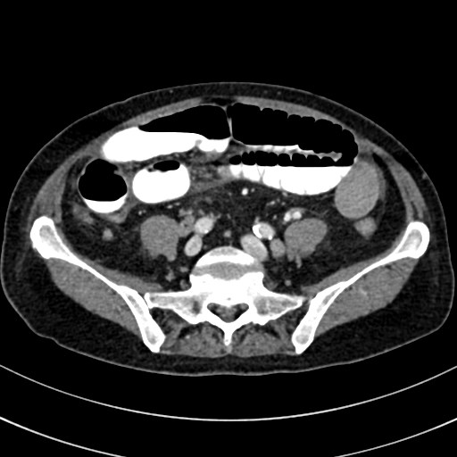 File:Broad ligament hernia (Radiopaedia 84802-100276 A 68).jpg