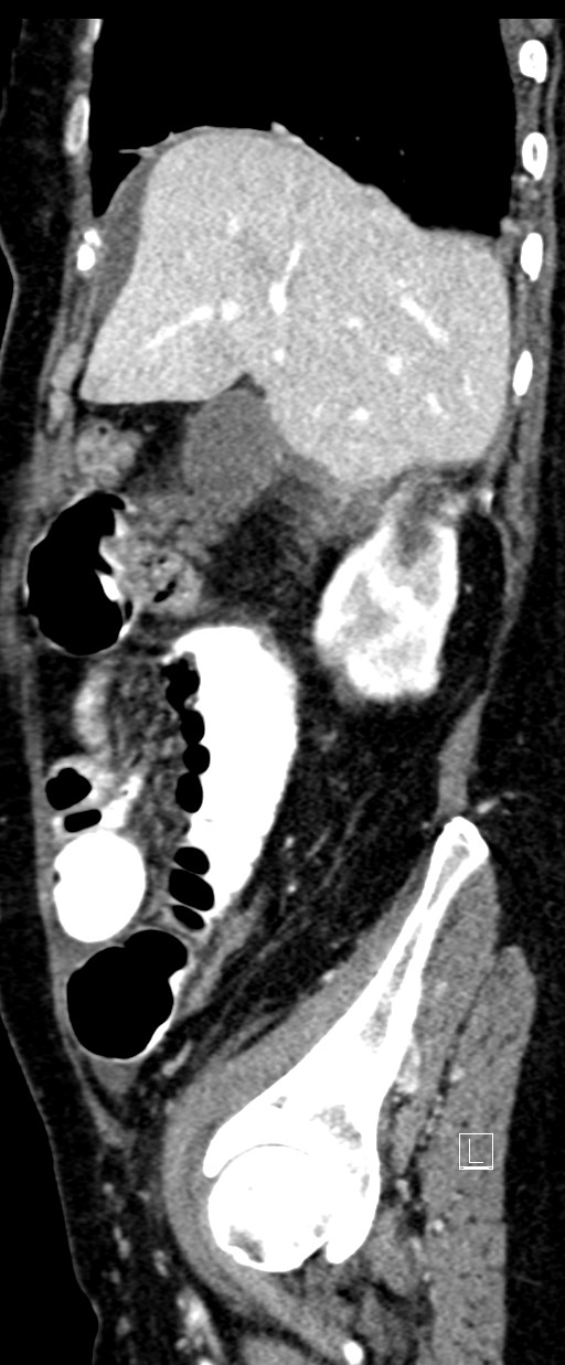 Broad ligament hernia (Radiopaedia 84802-100276 C 63).jpg