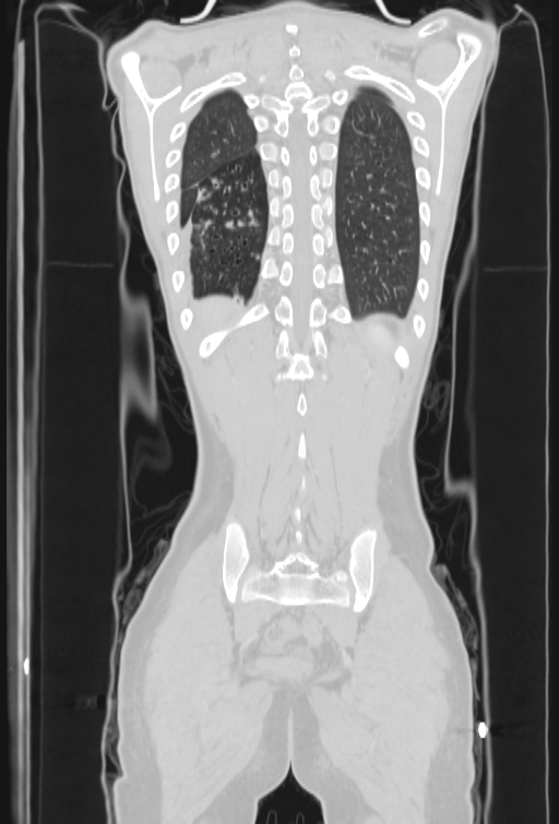 Bronchial carcinoid tumor (Radiopaedia 57187-64090 Coronal lung window 95).jpg