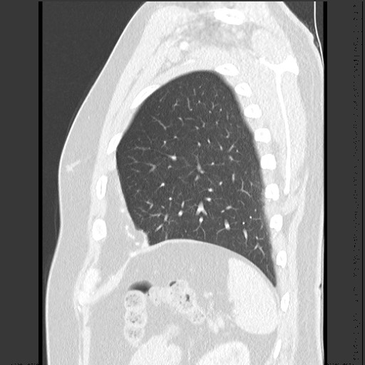 File:Bronchial carcinoid tumor (Radiopaedia 67377-76764 Sagittal lung window 57).jpg